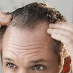 COMMON QUESTIONS ABOUT HAIR TRANSPLANTATION