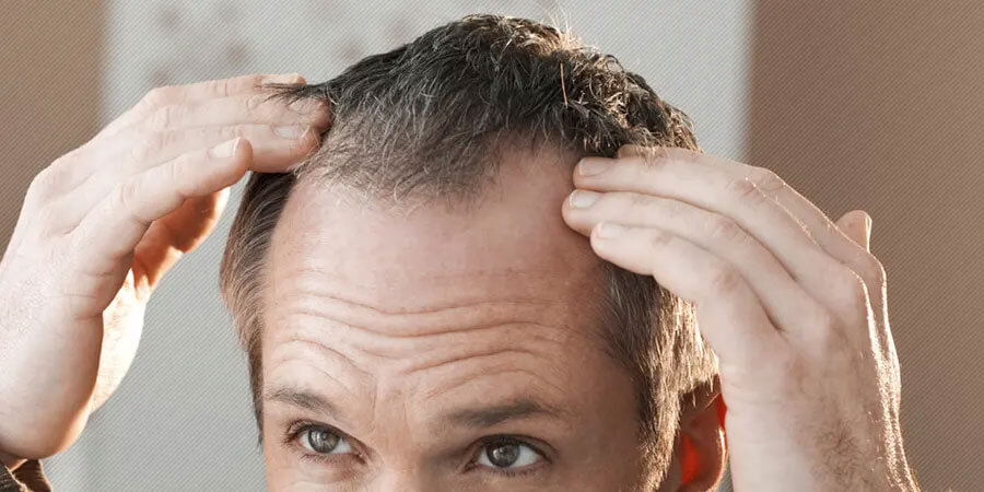 COMMON QUESTIONS ABOUT HAIR TRANSPLANTATION