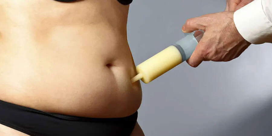 WILL FAT COME BACK AFTER LIPOSUCTION ?