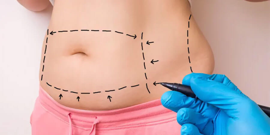 FOUR FACTS THAT AFFECT YOUR LIPOSUCTION RESULT
