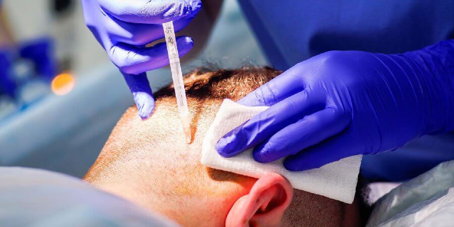 WHEN IS THE BEST AGE FOR HAIR TRANSPLANTATION?