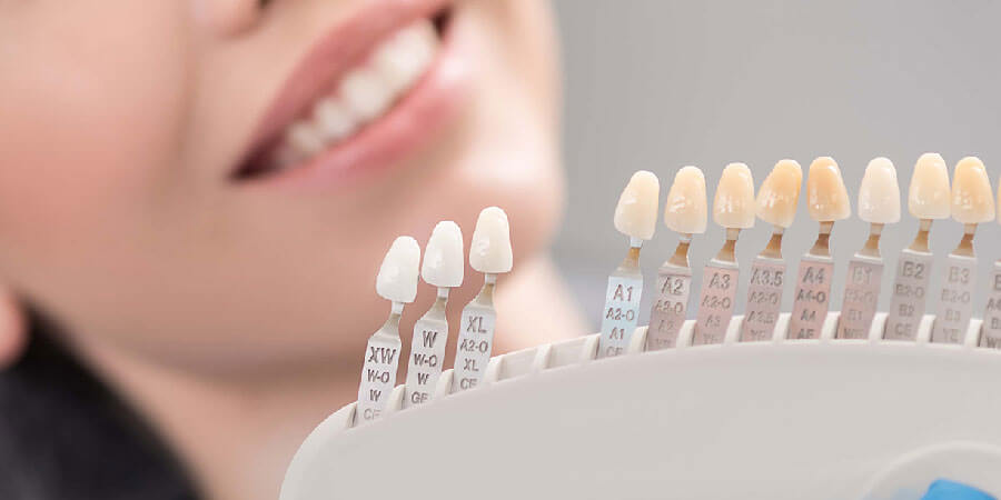 ALL YOU NEED TO KNOW ABOUT VENEERS