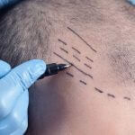 WHAT ARE THE BEST HAIR TRANSPLANT METHODS?