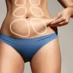 Tummy Tuck Scars: What To Expect And How To Minimize Them?