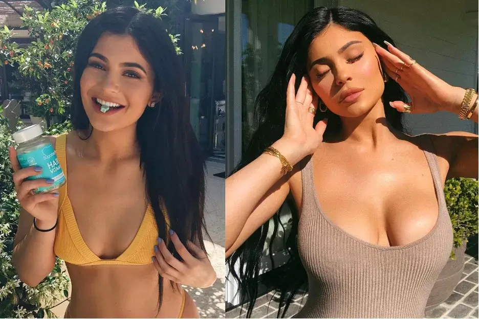 Kylie Jenner Before and After Plastic Surgery